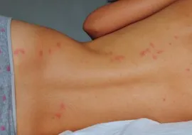 A kezelés utáni acne, hogyan lehet megszabadulni a - a legjobb eszköz a pattanások (akne utáni) post-akne kezelés, hogyan lehet megszabadulni - a legjobb orvosság foltok