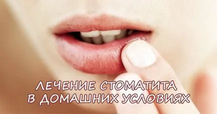 stomatitis kezelésére felnőtteknél népi jogorvoslati
