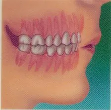 Malocclusion fogak