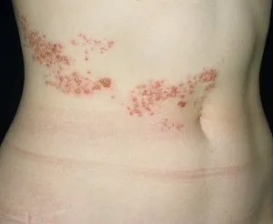 Az övsömör kezelni otthon népi jogorvoslati (övsömör kezelésére népi jogorvoslat) Az övsömör kezelésére otthon népi jogorvoslati