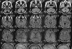A különbség az MRI eljárást anélkül, hogy a kontraszt és a kontraszt (kontraszt) A különbség az MRI eljárást anélkül, hogy a kontraszt és a kontraszt