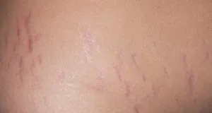 Striák a bőrön - mi a teendő