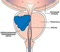 Előírásai prosztatagyulladás keresztül propolisz kivonat (prostatitis) Előírásai prosztatagyulladás keresztül propolisz kivonat