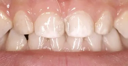 Ezüstös tejfogak véleménye, Komorowski előtt és után, alternatívák (Komorowski) Ezüstös tejfogak véleménye, Komorowski előtt és után, alternatívák