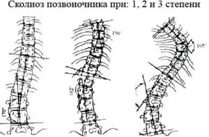 Meghatározására szolgáló módszerek fokú scoliosis és