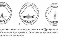 nyelv frenulum