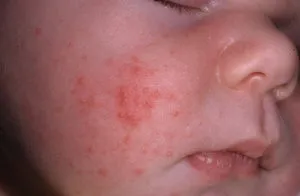 akne allergia