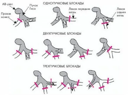 Mi hiányos szív-blokk Mi hiányos szív-blokk