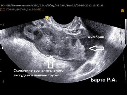 Salpingography mi ez Salpingography mi ez