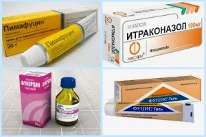 A kezelés a gomba a lágyéki A kezelés a gomba a lágyéki