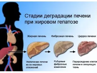 Mi zsírmáj kezelésére Mi zsírmáj kezelésére
