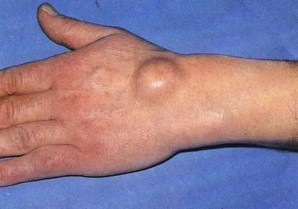 Hygroma ecset kezelés Hygroma ecset kezelés