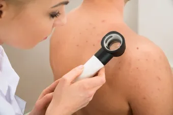 Mit tegyünk, ha pattanások a hátán