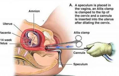 Hogyan abortuszra Hogyan abortuszra