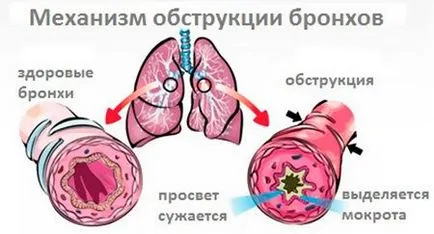 A krónikus obstruktív bronchitis kezelésére
