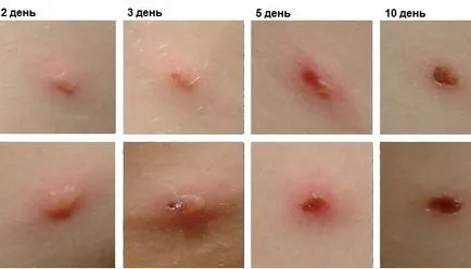A bárányhimlő, hogyan néz ki