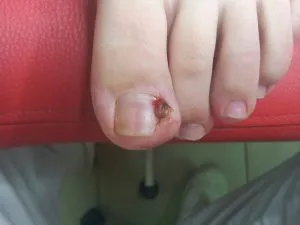 Kezelésére benőtt köröm otthon