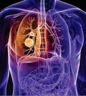 A krónikus obstruktív bronchitis kezelésére