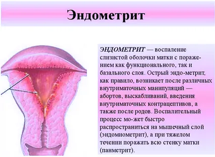krónikus endometritis kezelése népi jogorvoslat