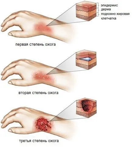 Ez terjedt el az égés Ez terjedt el az égés