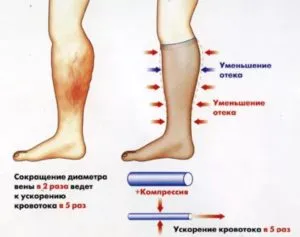Mi lymphostasis lábak
