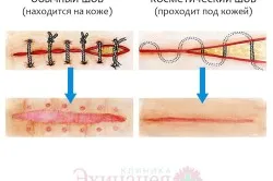 Mivel a seb gyógyul a műtét után