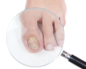 onychomycosis köröm kezelés onychomycosis köröm kezelés