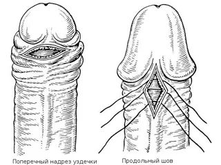 frenulum kezelés frenulum kezelés