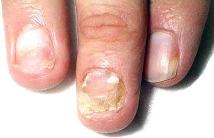 onychomycosis köröm kezelés