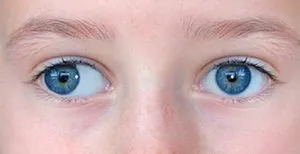 Nystagmus, mi ez