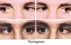 Nystagmus, mi ez