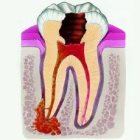 periodontitis kezelésére gyermekeknél periodontitis kezelésére gyermekeknél