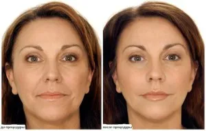 Peeling otthon gyümölcssavak