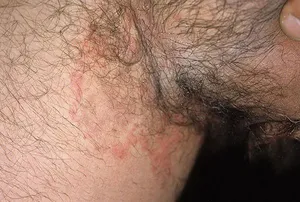 A kezelés a gomba a lágyéki A kezelés a gomba a lágyéki