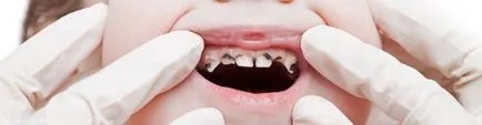 periodontitis kezelésére gyermekeknél