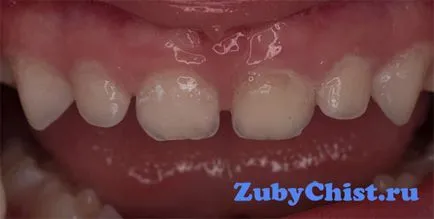 periodontitis kezelésére gyermekeknél