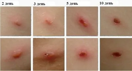 A bárányhimlő, hogyan néz ki A bárányhimlő, hogyan néz ki