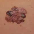 Miért mol viszket Miért mol viszket