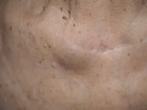 A dudorok a bőr alatt, ami