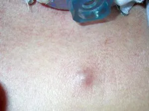 A dudorok a bőr alatt, ami