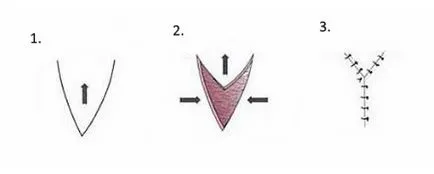 frenulum kezelés frenulum kezelés