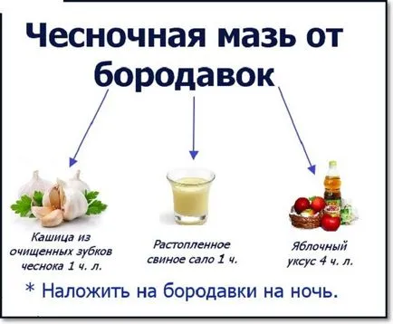 Hogyan lehet eltávolítani a talpi szemölcsök