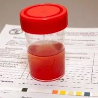 Ebből vörösvértestek a vizeletben