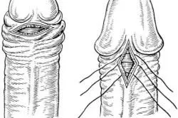frenulum kezelés