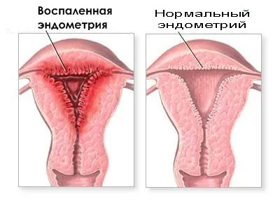 krónikus endometritis kezelése népi jogorvoslat
