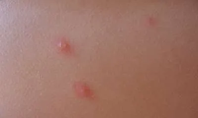 A bárányhimlő, hogyan néz ki