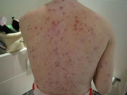 A bárányhimlő, hogyan néz ki A bárányhimlő, hogyan néz ki