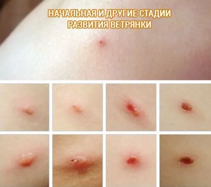 A bárányhimlő, hogyan néz ki A bárányhimlő, hogyan néz ki