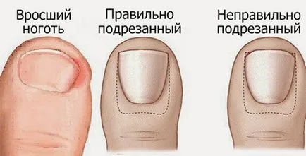 Kezelésére benőtt köröm otthon Kezelésére benőtt köröm otthon