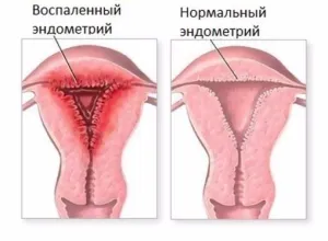 krónikus endometritis kezelése népi jogorvoslat krónikus endometritis kezelése népi jogorvoslat